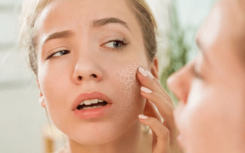 Dry Skin